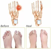 1 Pair of Metatarsal Sore Ball Forefoot Cushion Pads-thumb3