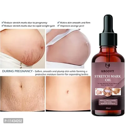 Stretch Marks Oil  Advance Repair Stretch Marks Removal - Natural Heal Pregnancy Breast, Hip, Legs, Mark Oil - 40 ml-thumb0