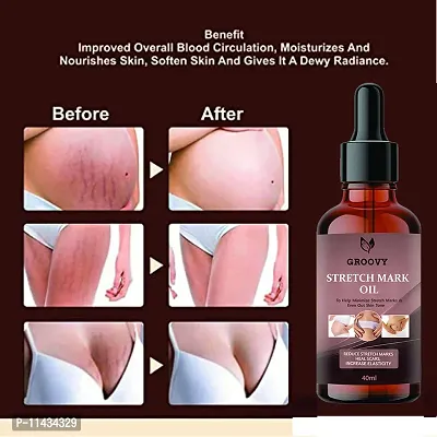 Stretch Marks Oil  Stretch Marks Scar Removal Cream Oil In During After Remover Scars- 40 ml-thumb0