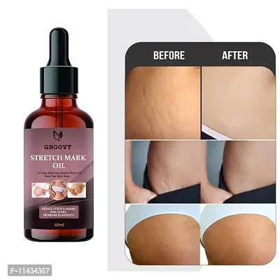 Stretch Marks Oil After Delivery Stretch Mark Removal Oil - 40 ml-thumb0