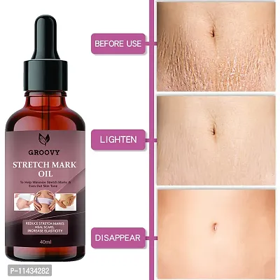 Stretch Marks Oil Anti Wrinkle Repair Stretch Marks Removal, Pregnancy Stretch Mark Oil- 40 ml-thumb0