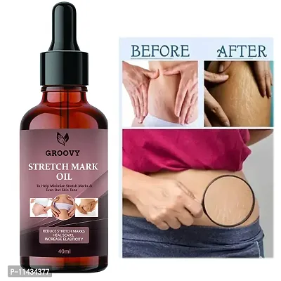 Stretch Marks Oil  Stretch Mark Oil For Moms- 40 ml-thumb0