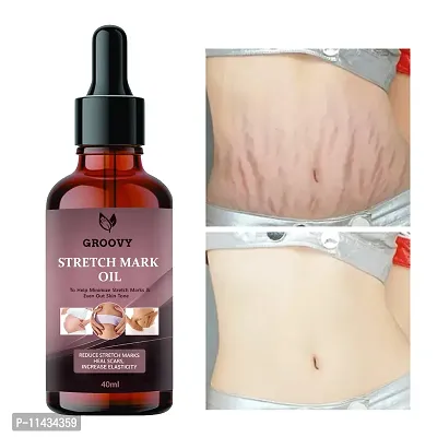 Stretch Marks Oil Unique Repair Stretch Marks Removal - Natural Heal Pregnancy Breast, Hip, Legs, Mark Oil 40  ml-thumb0