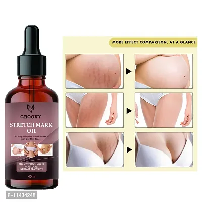 Stretch Marks Oil Unique Repair Stretch Marks Removal - Natural Heal Pregnancy Breast, Hip, Legs, Mark Oil 40  ml-thumb0