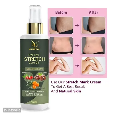 Nainital Anti Stretch Mark Removal Oil Women And Men, Marks And Spots Removal - 100 ml-thumb0