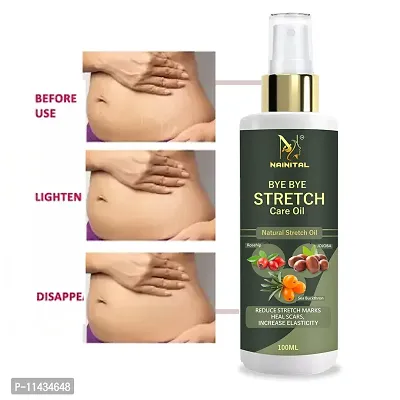 Nainital  Stretch Marks Scar Removal Cream Oil In During After Remover Scars- 100 ml - 100 ml-thumb0