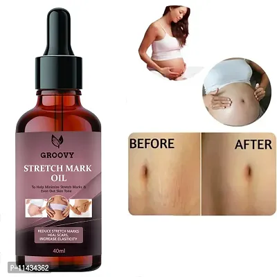 Stretch Marks Oil Present Repair Stretch Marks Removal Cream - Natural Heal Pregnancy Breast, Hip, Legs, Mark Oil - 40 ml-thumb0