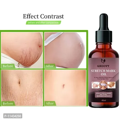 Stretch Marks Oil  Natural Stretch Oil With Coconut, Olive And Jojoba Oils, For Scars And Stretchmarks- 40 ml