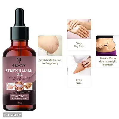 Stretch Marks Oil   Stretch Mark Removal Oil For Men And Women- 40 ml