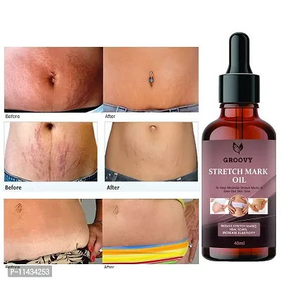 Stretch Marks Oil  After Delivery 100% Effective And No Chemical  40 ml-thumb0