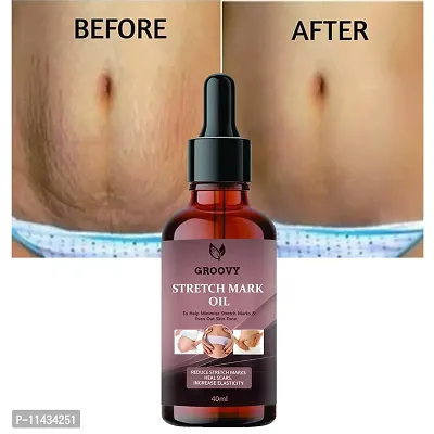 Stretch Marks Oil Present Repair Stretch Marks Removal Cream - Natural Heal Pregnancy Breast, Hip, Legs, Mark Oil - 40 ml-thumb0