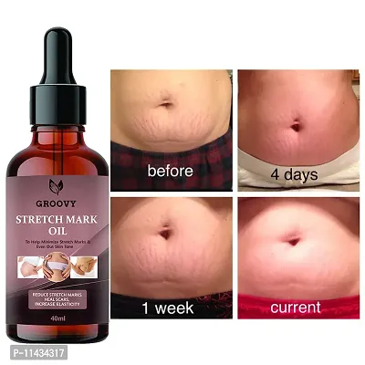 Stretch Marks Oil  Present Stretch Marks Removal Oil - Natural Heal Pregnancy, , Legs, Mark Oil - 40 ml-thumb0