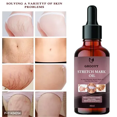 Stretch Marks Oil  Present Stretch Marks Removal Oil - Natural Heal Pregnancy, , Legs, Mark Oil - 40 ml