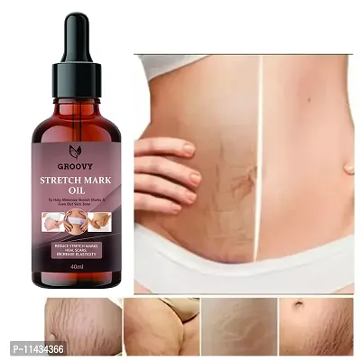 Stretch Marks Oil  After Delivery Stretch Mark Removal Oil 40 ml-thumb0