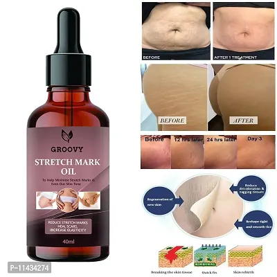 Stretch Marks Oil  Body Stretch Mark Removal Oil- 40 ml-thumb0