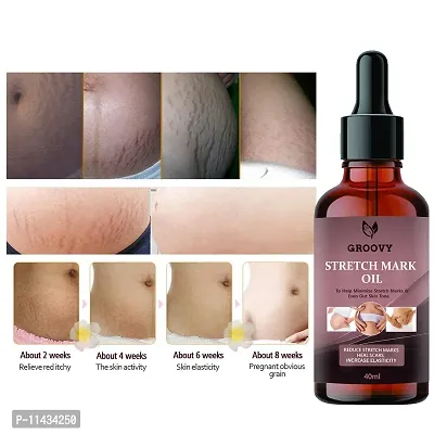 Stretch Marks Oil Pregnancy And Maternity Stretch Marks Removal Cream Stretch Marks  Oils 40 ml