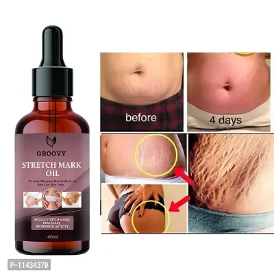 Stretch Marks Oil  Advance Repair Stretch Marks Removal - Natural Heal Pregnancy Breast, Hip, Legs, Mark Oil - 40 ml-thumb0