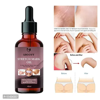 Stretch Marks Oil Present Repair Stretch Marks Removal - Natural Heal Pregnancy Breast, Hip, Legs, Mark Oil 40  ml