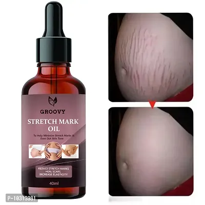 Stretch Marks Oil Anti Stretch Mark Removal Oil Women And Men,Marks And Spots Removal 40 Ml-thumb0
