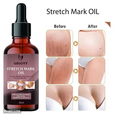 Stretch Marks Oil To Minimize Stretch Marks And Even Out Skin Tone-40 Ml-thumb0