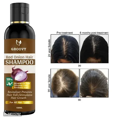 Red Onion Hair Shampoo For Hair Growth, Anti-Hair Fall, Anti-Dandruffall, Natural Ingredients, Suitable For All Hair Types - Hair Shampoo 100 Ml-thumb0