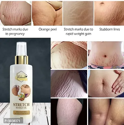 Trendy Present Repair Stretch Marks Removal - Natural Heal Pregnancy Breast, Hip, Legs, Mark Oil 100 Ml Pack Of 1