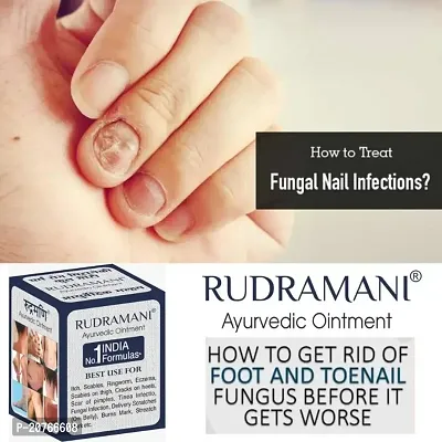 Rudramani Ayurvedic  Malam For Anti Dad Khaj khujli Skin fungal Infection, itching, Skin Tretment, Ringworm, Eczema, Burn Mark, Foot Crack Care 25G
