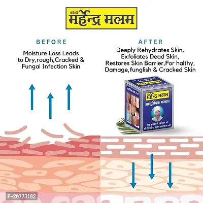 Shreeji Marhendra Malam For Dad Khaj Khujali  Ointment  Skin fungal Infection, Skin Care, itching, Skin Tretment, Ringworm, Eczema, Scabies  25 GR-thumb4