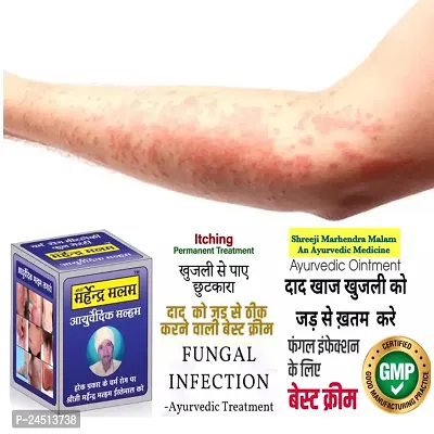 Shreeji Marhendra Itching Malam For Fungal Infection, Skin Treatment, Eczema, Ringworm 25 G-thumb0