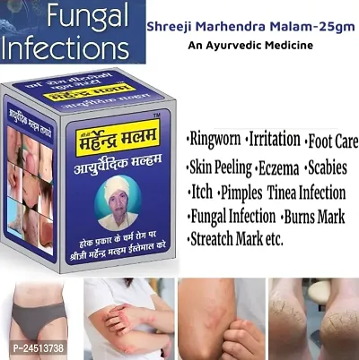 Shreeji Marhendra Itching Malam For Fungal Infection, Skin Treatment, Eczema, Ringworm 25 G-thumb3