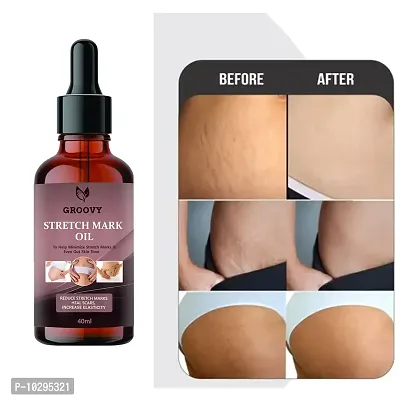 Stretch Marks Oil After Delivery Stretch Mark Removal Oil Organic Oil 40Ml