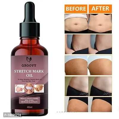 Stretch Marks Oil Therapy Oil For Stretch Marks, Scars And Skin Toning - 40Ml With Argan Oil-thumb0