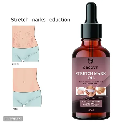 After Delivery Stretch Mark Removal Oil 40Ml