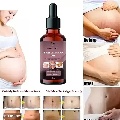 Stretch Marks Oil Pregnancy And Maternity Stretch Marks Removal Cream Stretch Marks Oils 40Ml-thumb0