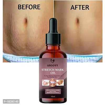 Stretch Marks Oil Present Repair Stretch Marks Removal Cream - Natural Heal Pregnancy Breast, Hip, Legs, Mark Oil 40 Ml-thumb0