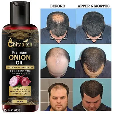 ONION OIL ANTI HAIR LOSS  HAIR GROWTH OIL WITH PURE ARGAN, BLACK SEED OIL IN PUREST FORM VERY EFFECTIVELY CONTROL HAIR LOSS, PROMOTES HAIR GROWTH 50ml