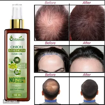 Red Onion Oil for Hair Regrowth Bio Active Hair Oil Nourshing Hair Treatment With Real Onion Extract Intensive Hair Fall Dandruff Treatment Hair Oilnbsp;nbsp;(100 ml)-thumb0
