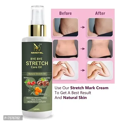 NAINITAL ANTI Stretch Mark Removal Oil Women  Men,Marks  Spots Removal (pack of 1)  (100 ml)