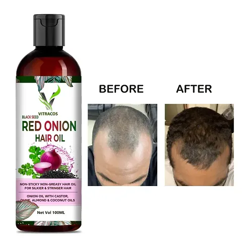 VITRACOS Onion Oil For Hair Regrowth And Hair Fall Control