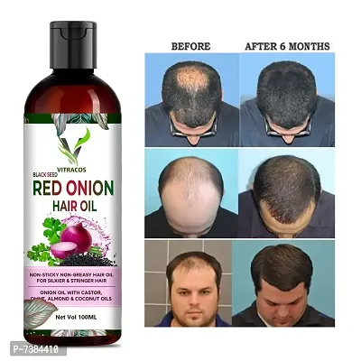 Onion Hair Oil for Hair ReGrowth and Hair Fall Control - With Black Seed Oil Hair Oilnbsp;nbsp;(100 ml)