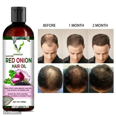 nbsp;Red Onion Hair Oilnbsp;Controls HairFall  Promotes Growth - Hair Oil 100ml