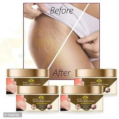 Stretch Marks Cream to Reduce Stretch Marks  Scars 50gm (PACK OF 4)