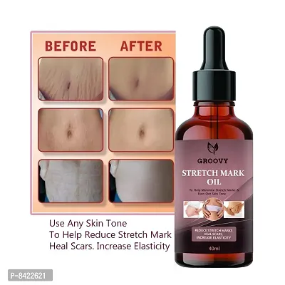 Strech Mark Oil For Anti-Strech Mark Cream 40ML (Pack Of 1)-thumb0