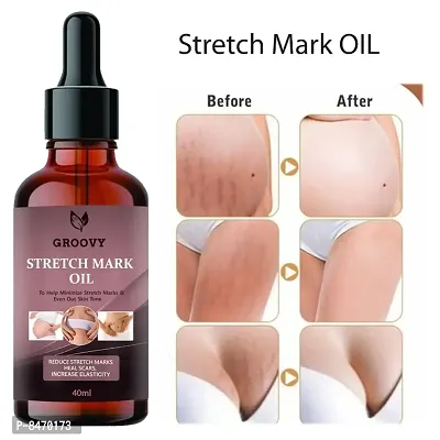 Strech Marks Oil 40Ml Pack Of 1