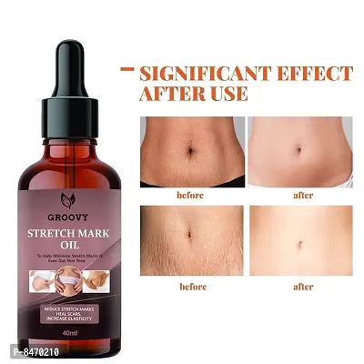 Strech Marks Oil 40Ml Pack Of 1