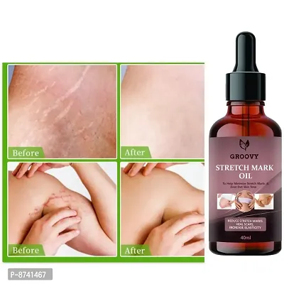 STRETCH MARKS OIL FOR ANTI STRETCH MARK PACK OF 1-thumb0