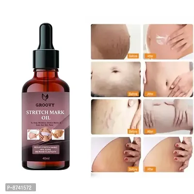 STRETCH MARKS OIL FOR ANTI STRETCH MARK PACK OF 1