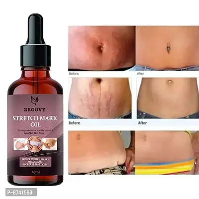 STRETCH MARKS OIL FOR ANTI STRETCH MARK PACK OF 1