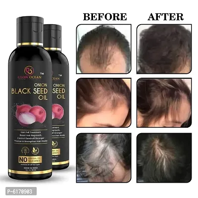 Ocean Onion Black Seed Oil For Hair Fall Control, Hair Growth and Hair Regrowth-Control Dandruff - Pack Of 2