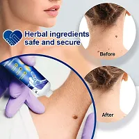 Warts Remover Ointment Wart Treatment Cream Skin Tag Remover Herbal Extract Warts Remover Ointment-thumb2